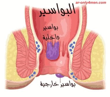 البواسير هى عبارة نوع من دوالى الاوردة وتحدث نتيجة تمدد الأوردة الموجودة حول فتحة الشرج , تحدث البواسير نتيجة ارتفاع ضغط هذه الاوردة الموجودة فى فتحة الشر