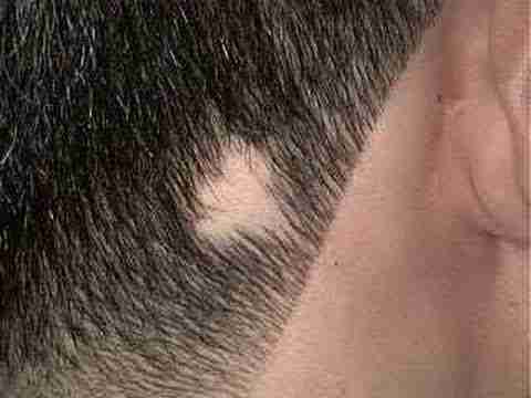 Treatment of alopecia