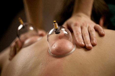 cupping therapy