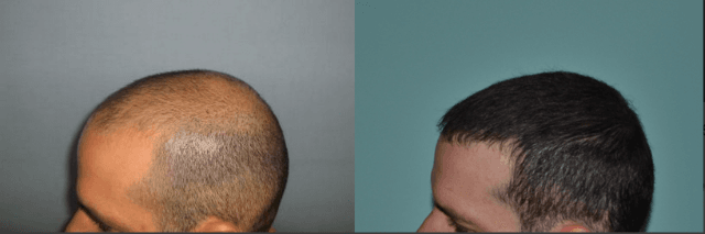 زراعة الشعر في السعودية