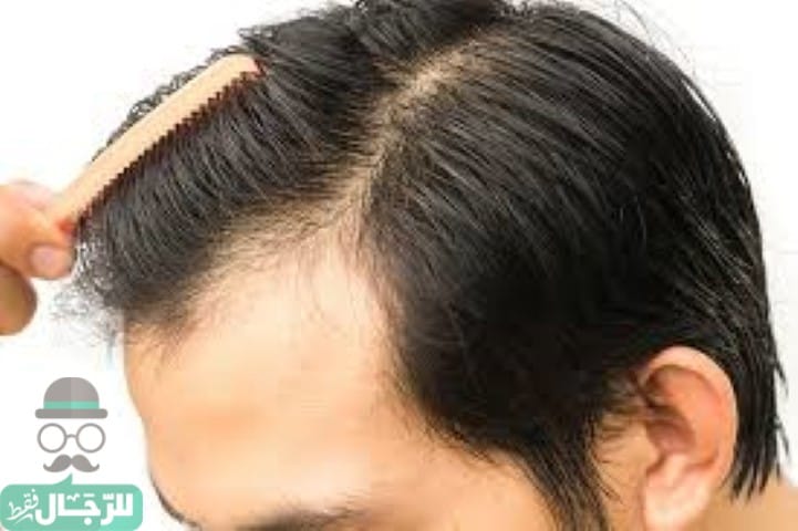 زراعة الشعر في دبي