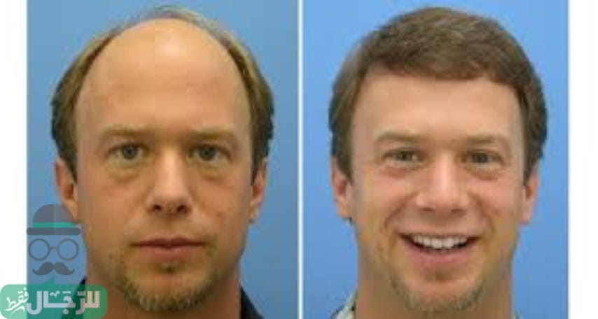 تكلفة زراعة الشعر في الامارات